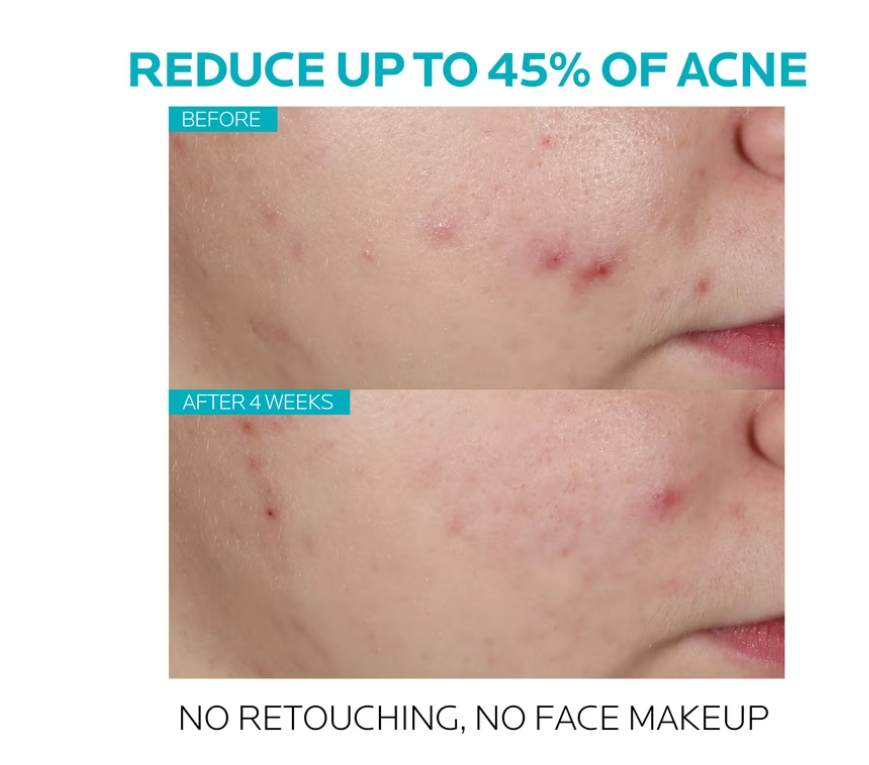 La Roche-Posay Effaclar Salicylic Acid Acne Serum, Pore Minimizing Acne Treatment with Niacinamide, 1.0 fl oz