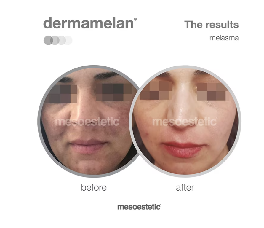 Mesoestetic Dermamelan Treatment Cream Pigment Control Solutions 30 g / 1.06 oz